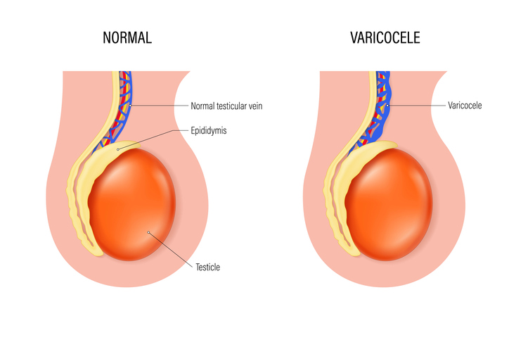 Varicocele vector. Comparison of normal testicular vein and varicocele. Testicular disease. Male reproductive system